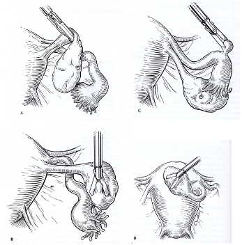 Umbilical Hernia - Boulder Valley Plastic Surgery