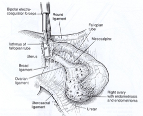 Laparoscopic Oophorectomy for Ovarian Torsion • Video •