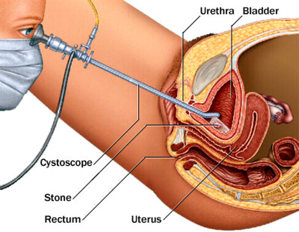 Society Of Laparoscopic Robotic Surgeons Cystoscopy